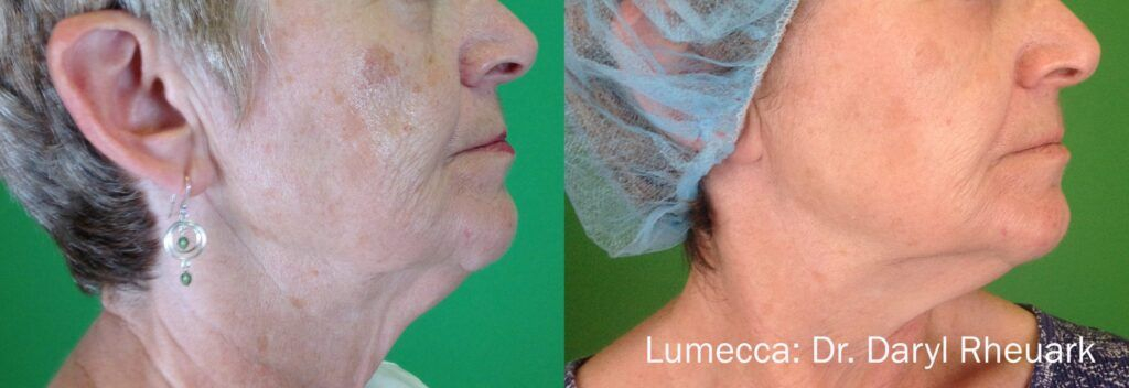 Lumecca Before And After - Lakewood Ranch Fl | Signature